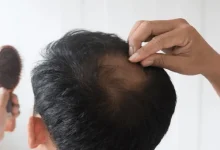 موی رفته دیگه هیچ وقت نمیاد؟