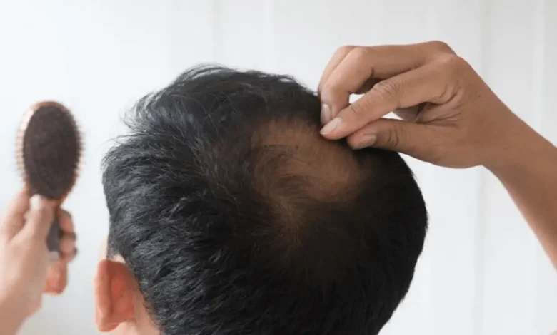 موی رفته دیگه هیچ وقت نمیاد؟ 1 موی رفته دیگه هیچ وقت نمیاد؟