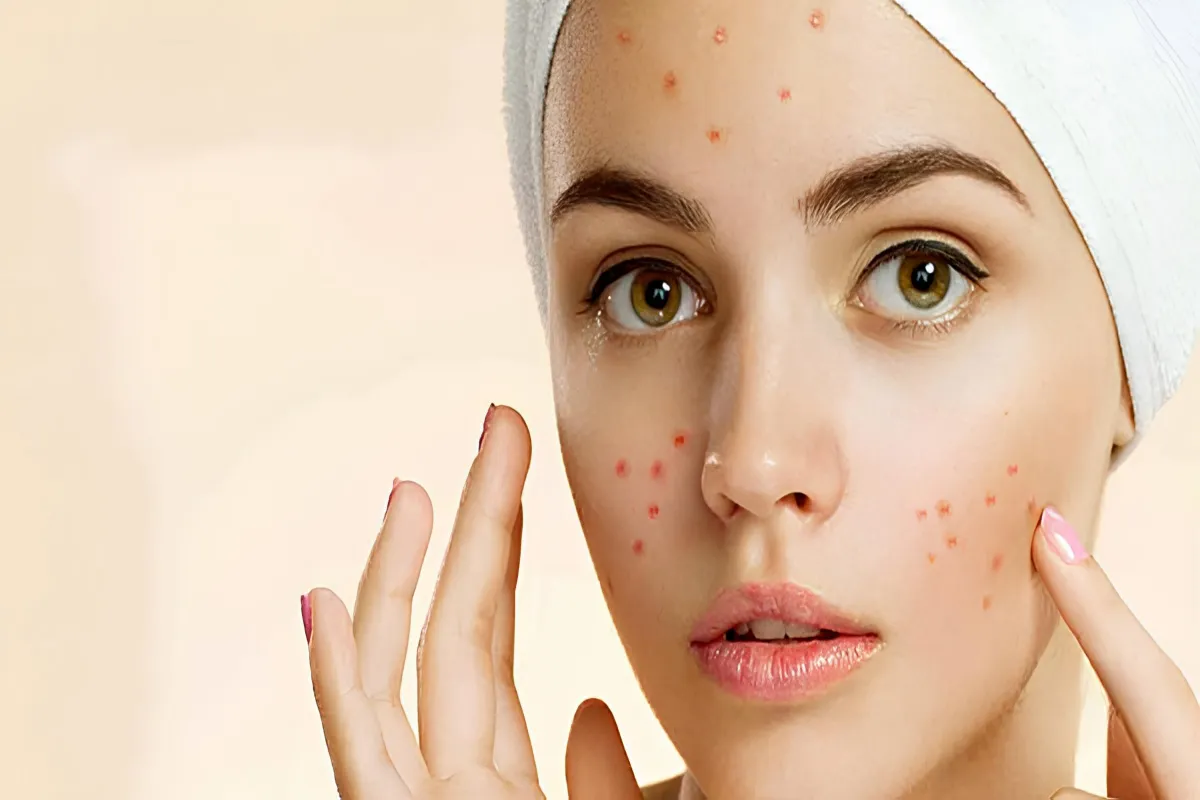 ویژگی‌های یک کرم ضد جوش باکیفیت