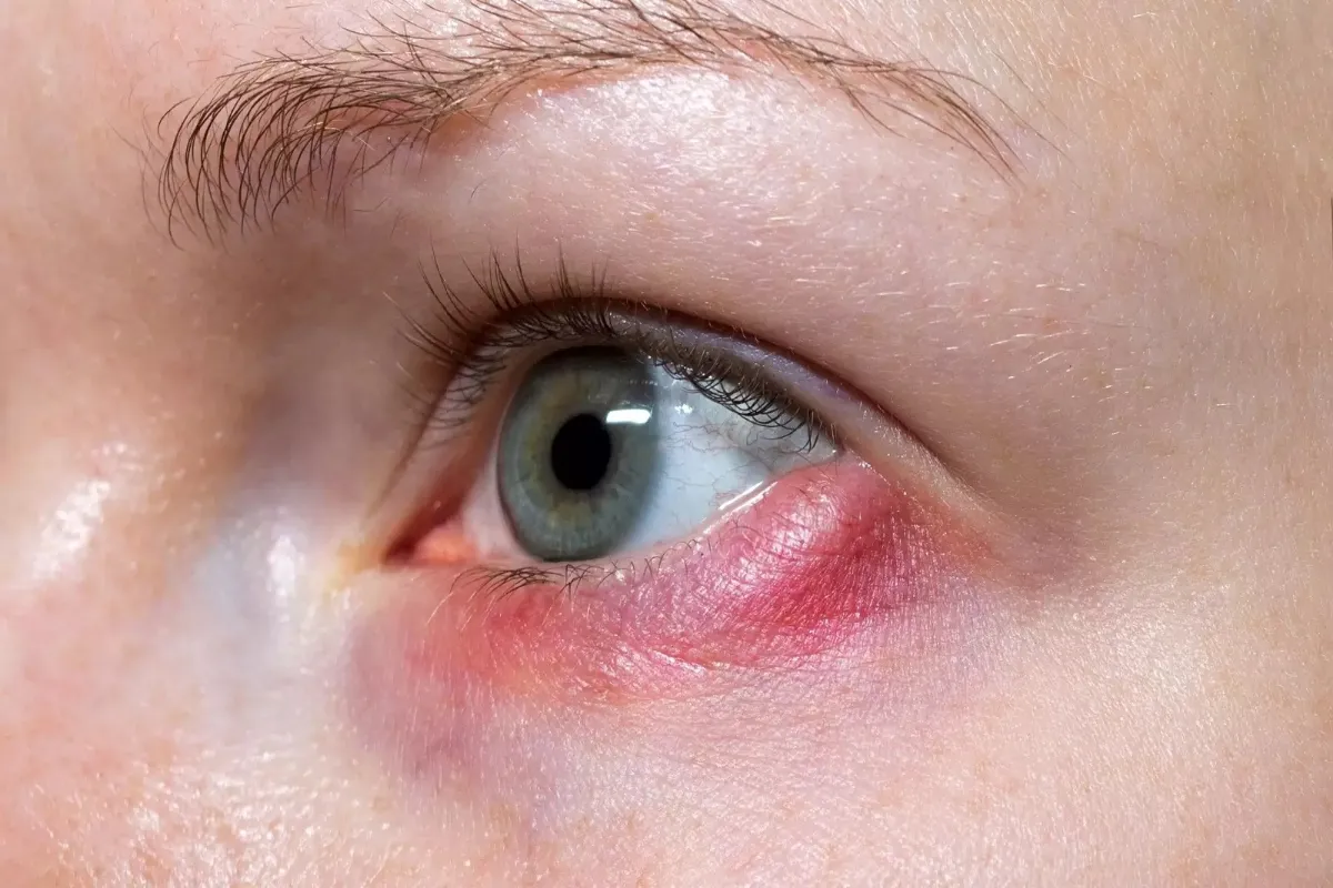 درمان سریع ورم چشم با روش های خانگی 4 آلرژی و حساسیت در ورم چشم